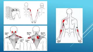 Myofascial pain management and trigger point therapy  Michalis Charalampidis [upl. by Odraleba338]