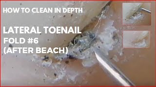 How to clean in depth lateral toenail fold 6 After beach [upl. by Ilsel]