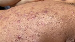 Blackheads amp Pimples Pore Removal New 2024  Acne Treatment With Bo Nguyễn Spa [upl. by Frasch]