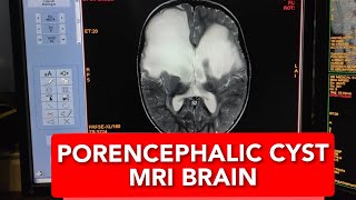 How to Read MRI Brain of 2 years Baby Diagnosing Large Porencephalic Cysts in English [upl. by Donnamarie]