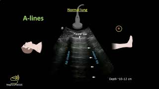 Introduction to lung ultrasound for the nephrologist I Dr Koratala NephroP [upl. by Sollie]