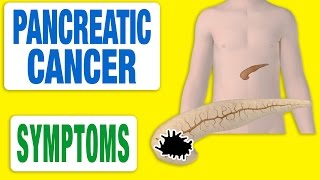 Pancreatic Cancer  All Symptoms [upl. by Erb]