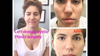 Scarless Congenital Droopy Upper Eyelid Ptosis Surgery in a young woman [upl. by Ecyned467]