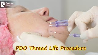 PDO Thread Lift Procedure How is it done Benefits and Side EffectsDrSrikanth V  Doctors Circle [upl. by Jarlath]