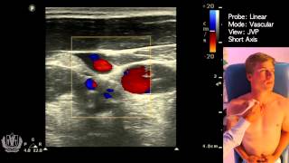 JVP Jugular Venous Pulsation Evaluation using Ultrasound [upl. by Tana]