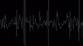 Myopathic R biceps 2 [upl. by Naghem]