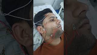 Needle Treatment For Face Paralysis  Facial Palsy  Dry Needling  Physiotherapy [upl. by Cuttler]