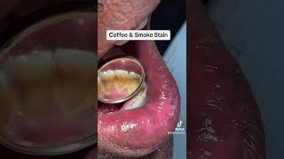 Rejuvenate Gums amp teeth with Deep Cleaning dentalcondition shortsvideo [upl. by Lorette]