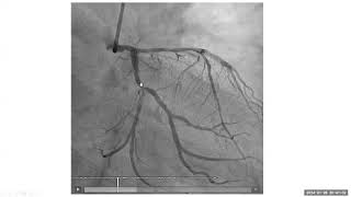 Coronary Angiography Cases Dr Abdullah Al khushail [upl. by Auohc]