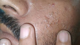 sac be spa blackheads elderly 2024  sac be spa old age blackheads 2024  sac be spa face scrub 4k [upl. by Ludovick477]