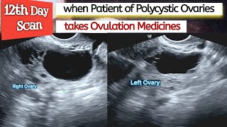 Ovarian CYSTS  Ovulation Medicines in PCOS Patient  Polycystic Ovaries  Infertility [upl. by Lotti]