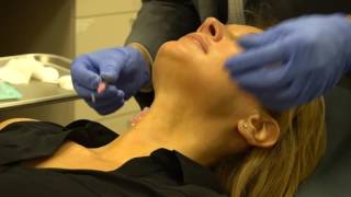 PDO NovaThreads Thread Lift for decolletage in NYC [upl. by Neelac]