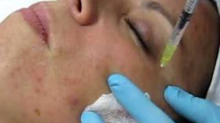 MESOTERAPIA FACIAL CON TERAPIA CELULAR [upl. by Solange]