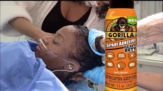 Woman FINALLY Gets Gorilla Glue out of hair with SURGERY [upl. by Tahmosh323]