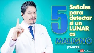 5 señales para detectar un lunar maligno cancer de piel melanoma II Dr Marino Dermatólogo [upl. by Griffith52]