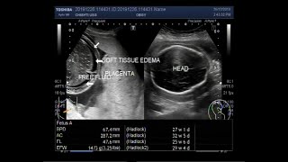 Ultrasound Video showing scanning of Pregnancy of about 28 weeks with fetal demise [upl. by Etterraj]