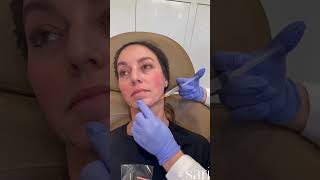 Behind the scenes of an appointment for Sculptra and Restylane Filler filler sculptra restylane [upl. by Tillie]