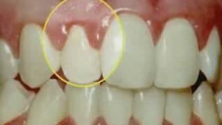 Periodontal Disease amp Treatment [upl. by Emse]