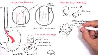 GORD GERD Gastro Oesophageal Reflux Disease  Overview pathophysiology treatment [upl. by Enitsirhk]