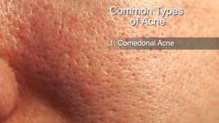 How to Treat Different Types of Acne [upl. by Nelrsa592]