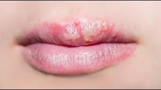 How to get rid of cold and canker sores  LVI TV Episode 34 [upl. by Dolores]