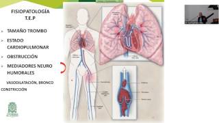 Tromboembolia pulmonar 2016 residencia udea [upl. by Hsaniva]