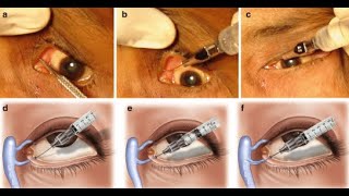 Probing and Dilators of surgical instruments [upl. by Eltsirc]