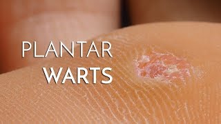 Plantar Warts Verrucas  Podiatrist Georgina Tay East Coast Podiatry [upl. by Itnaihc]