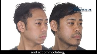 Jaw surgery Case  101 Kendrick  Sleep Apnea Maxillomandibular Retrusion [upl. by Yrtsed]