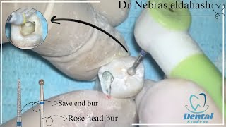 Badly Decayed Lower Molar Access cavity preparation [upl. by Stoneman]