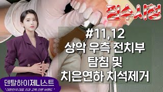 상악 우측 전치부 탐침 및 치은연하 치석제거 1112 Explorer Gracey curette 익스플로러 그레이시큐렛  치과위생사 국가고시 실기시험 [upl. by Adnam]