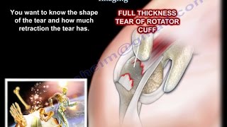 Rotator Cuff tear Imaging  Everything You Need To Know  Dr Nabil Ebraheim [upl. by Rocker532]