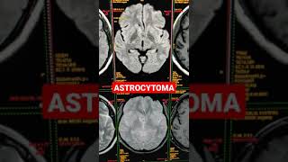 Imaging Tumors  Astrocytoma [upl. by Hembree]