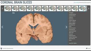 Neuroanatomy  Basal Ganglia in Brain Cross Sections [upl. by Kleiman560]