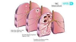 Verem Tüberküloz Nasıl Tedavi Edilir [upl. by Ennovaj]