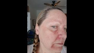 Day 14 Fluorouracil 5 Treatment Basal Cell Carcinoma Actinic Keratosis 11823 5FU Efudex [upl. by Ofella]