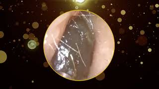 Hard Dark Stubborn Ear Wax Removal [upl. by Giliane]