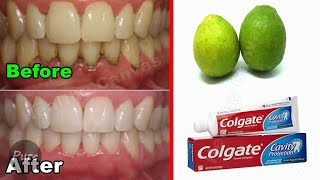 Just In 3 Minutes Turn Yellow TEETH To Pearl White  Teeth Whitening Remedy [upl. by Kee]