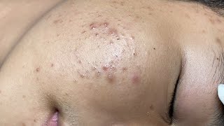 ACNE TREATMENT VU QUYNH MI  Blackheads On Boy Face 2024FULL [upl. by Ain379]