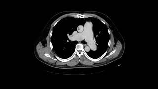 Hipertensão pulmonar [upl. by Biebel]