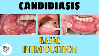 CANDIDIASIS  BASIC INTRODUCTION [upl. by Boudreaux425]