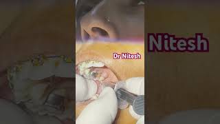 Inferior alveolar nerve block [upl. by Hekking]