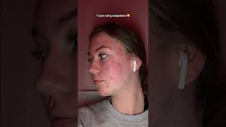 Ellas acne journey [upl. by Noseyt]