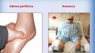 CASE Presentation of ANASARCA  Medicine [upl. by Arrej]