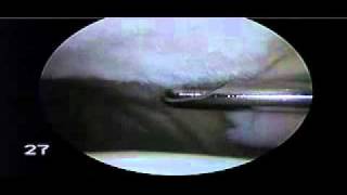 Chondroplasty Patella for Chondromalacia Patella  Dr Steven Struhl [upl. by Reviere]