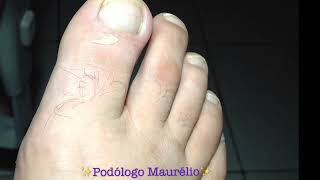 UNHA COM MUITO PUS NAIL WITH A LOT OF PUS  PODÓLOGO MAURÉLIO [upl. by Nirihs982]