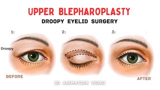 Droopy Upper Eyelid Surgery  Blepharoplasty 👁️ [upl. by Bourke]