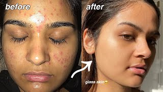 how i cleared my acne FOR GOOD something finally worked [upl. by Papert]