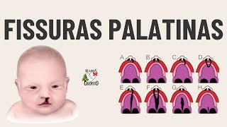 FISSURAS LABIOPALATINAS  RESUMOS DE ODONTO [upl. by Sabas]