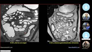 Colitis Ulcerosa Evaluacion Ecografica [upl. by Theo]